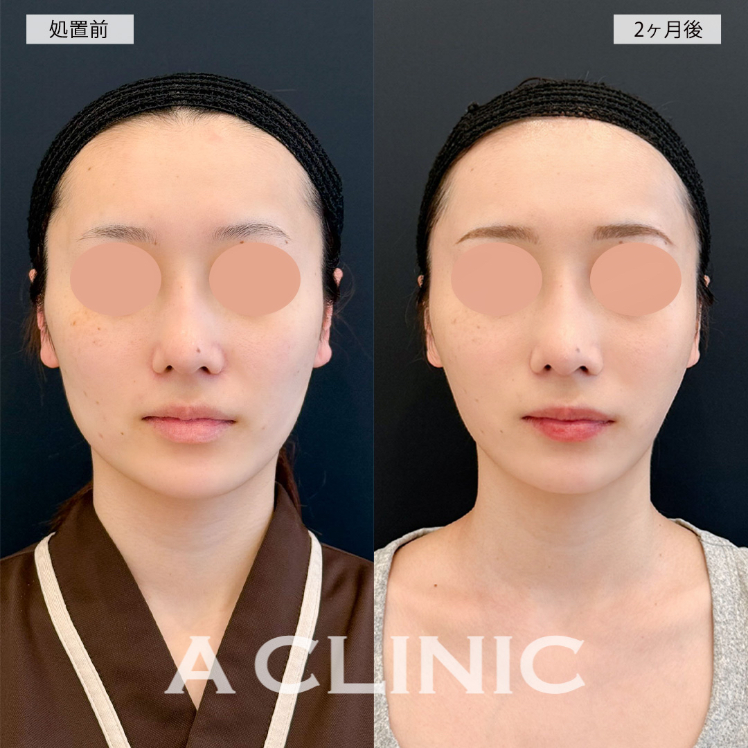 1day小顔脂肪吸引で顔全体が小さくなり女性らしい卵型の輪郭に！こちら処置前と2ヶ月後の症例です(20代女性)