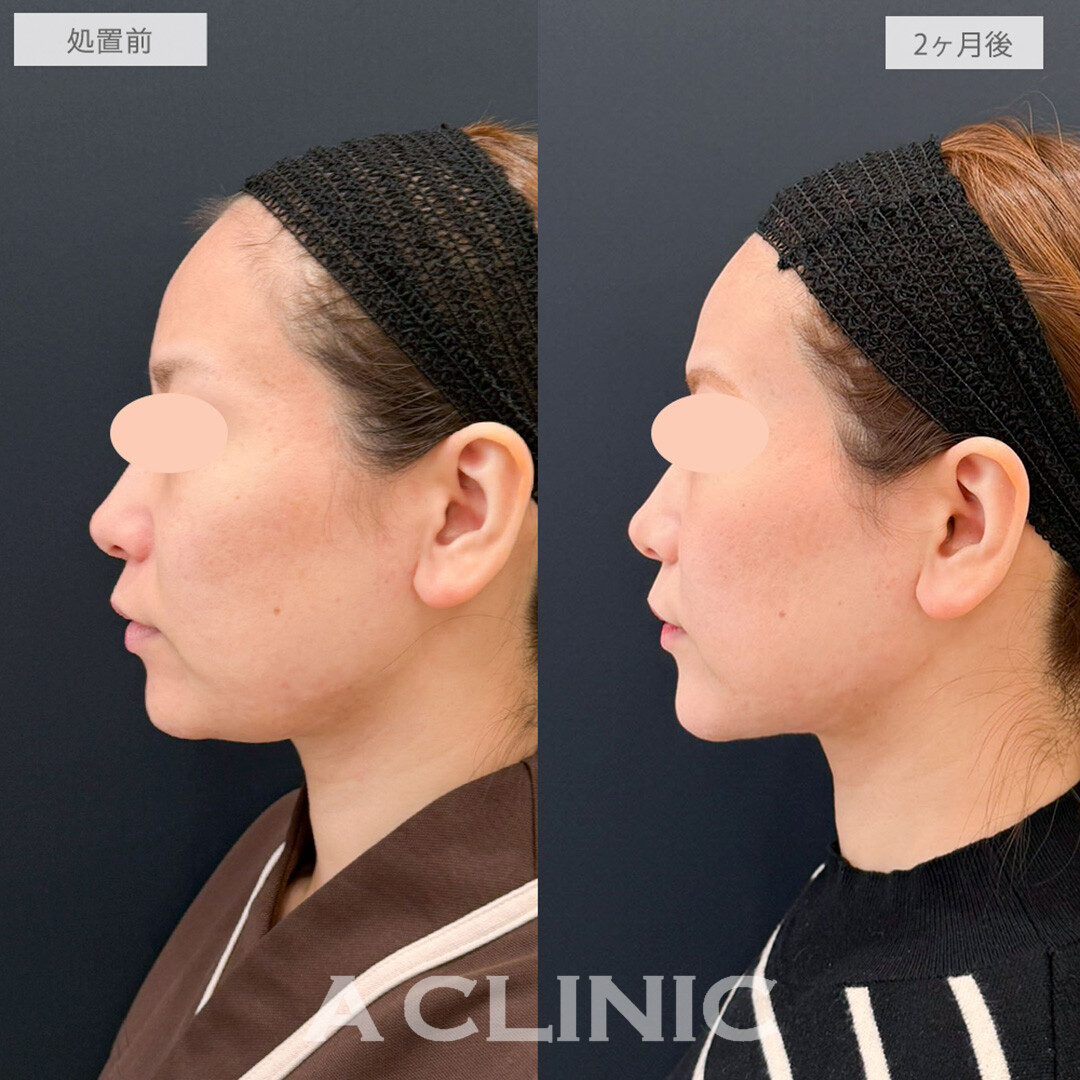 1day小顔脂肪吸引とあごへのヒアルロン酸注入でアゴ下スッキリ横顔美人に！こちら処置前と2ヶ月後の症例です(30代女性)