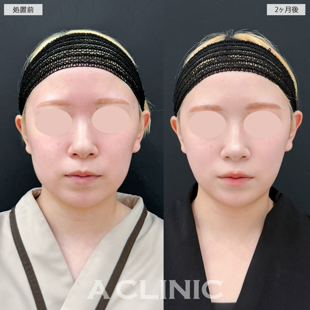 1day小顔脂肪吸引と頬へのヒアルロン酸注入で引き締めつつ丸みのあるお人形さんのようなフェイスラインに！処置前と2ヶ月後の症例です(20代女性)