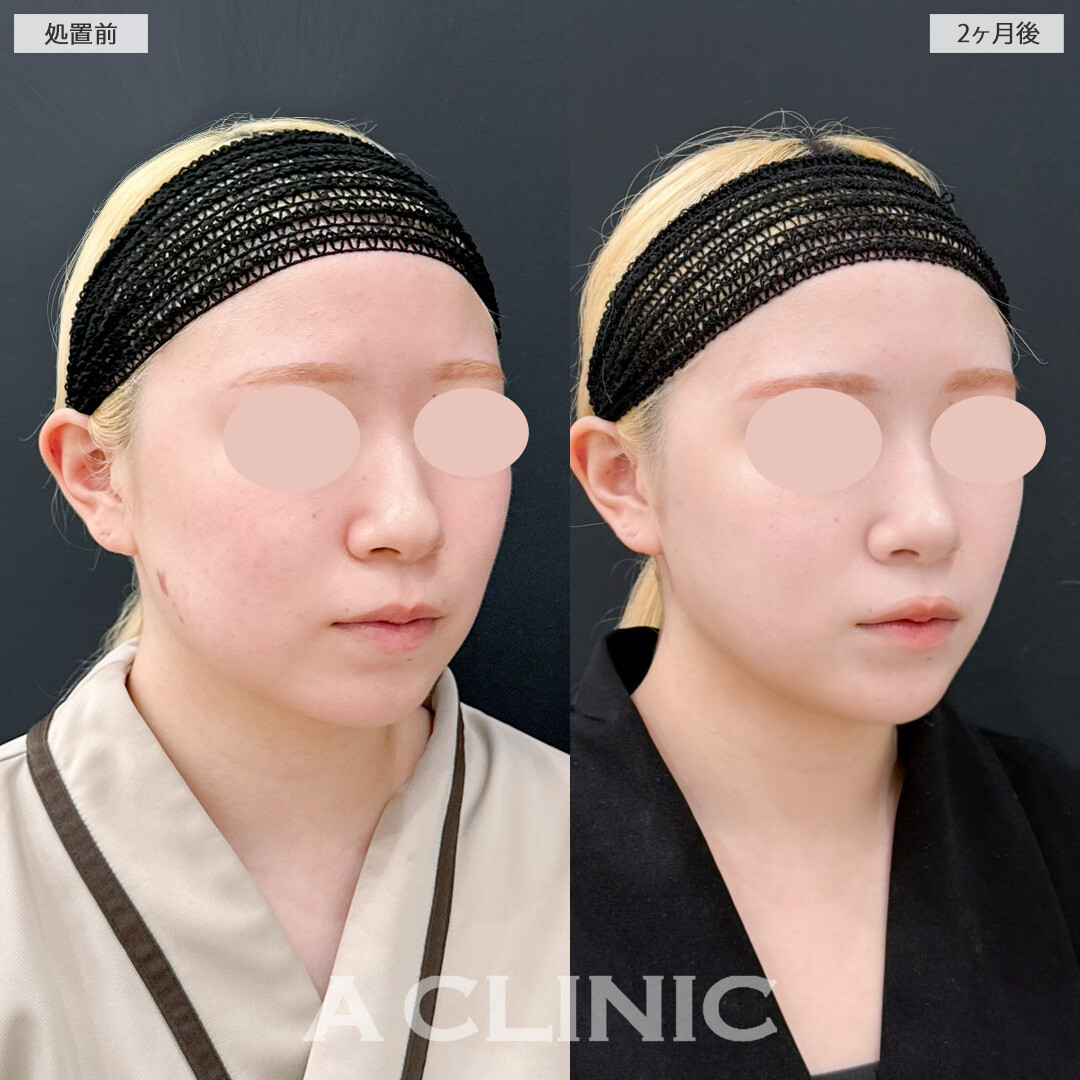 1day小顔脂肪吸引と頬へのヒアルロン酸注入で引き締めつつ丸みのあるお人形さんのようなフェイスラインに！処置前と2ヶ月後の症例です(20代女性)