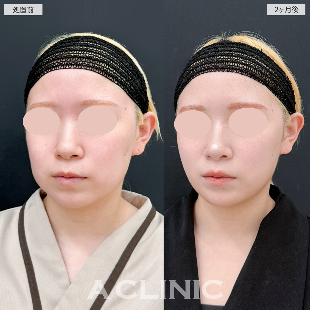 1day小顔脂肪吸引と頬へのヒアルロン酸注入で引き締めつつ丸みのあるお人形さんのようなフェイスラインに！処置前と2ヶ月後の症例です(20代女性)