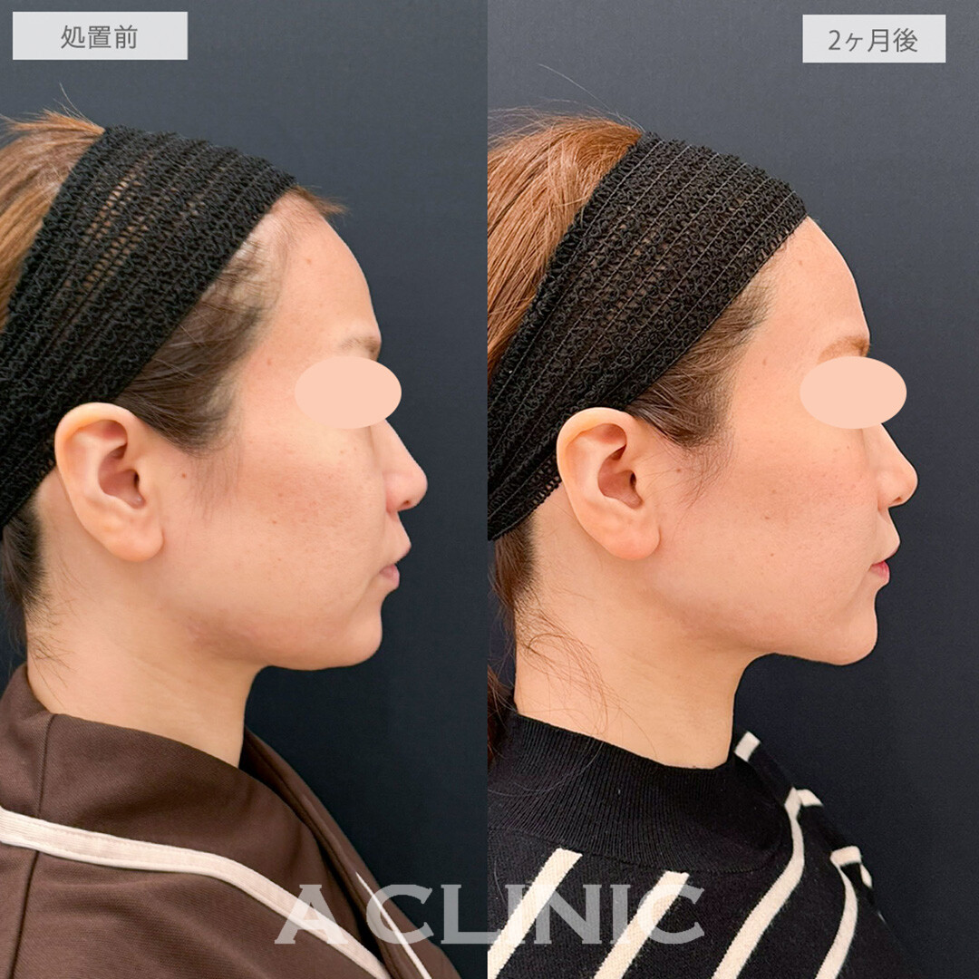 1day小顔脂肪吸引とあごへのヒアルロン酸注入でアゴ下スッキリ横顔美人に！こちら処置前と2ヶ月後の症例です(30代女性)