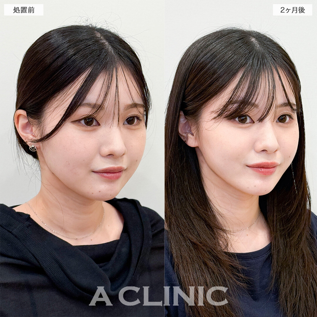 1day小顔脂肪吸引で部分痩せが叶いました！処置前と2ヶ月後の症例です(20代女性)
