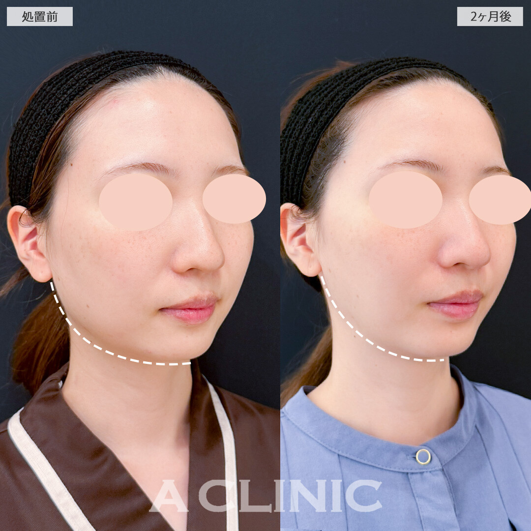 1day小顔脂肪吸引と小顔エラボトックスで下顔面のボリュームダウンに成功！処置前と2ヶ月後の症例です(20代女性)