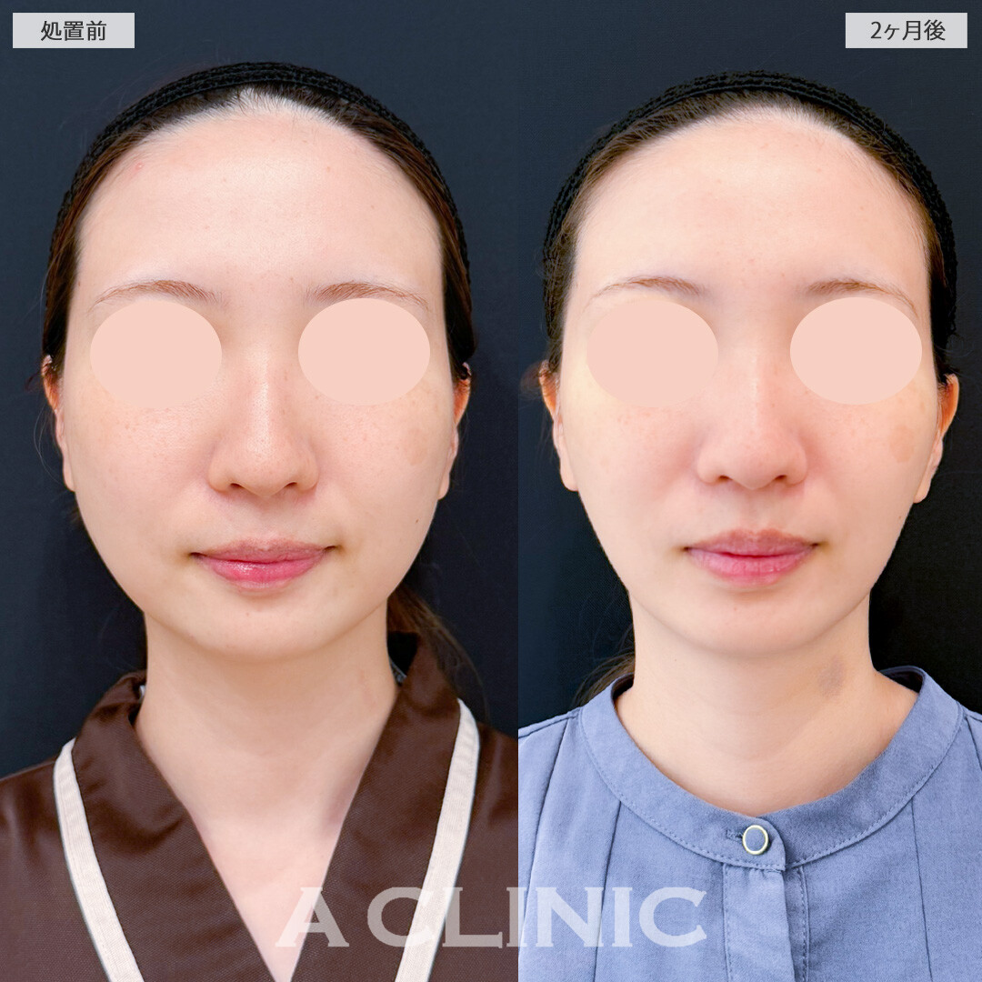 1day小顔脂肪吸引と小顔エラボトックスで下顔面のボリュームダウンに成功！処置前と2ヶ月後の症例です(20代女性)