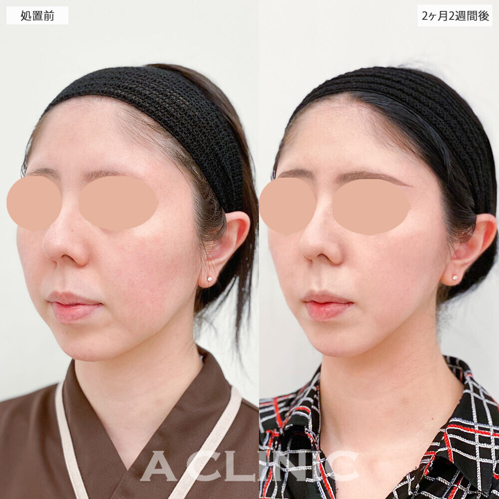 1day小顔脂肪吸引で加工無しでもVフェイスに！こちら処置前から2ヶ月2週間後の症例です(20代女性)