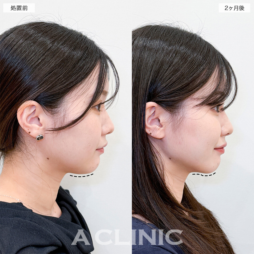 1day小顔脂肪吸引で部分痩せが叶いました！処置前と2ヶ月後の症例です(20代女性)