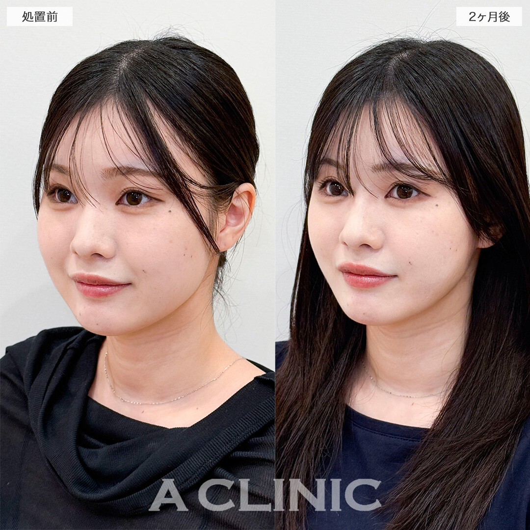1day小顔脂肪吸引で部分痩せが叶いました！処置前と2ヶ月後の症例です(20代女性)