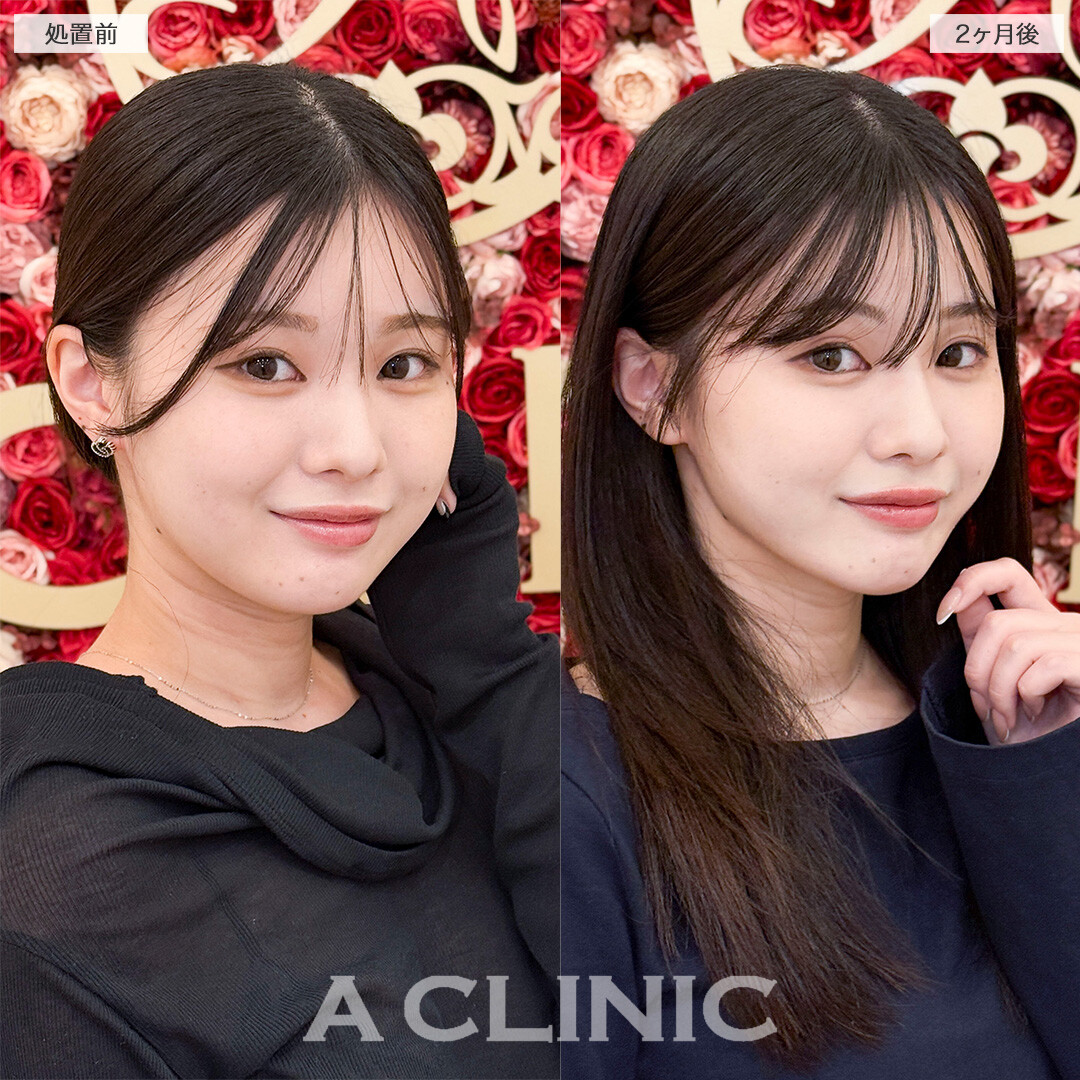 1day小顔脂肪吸引で部分痩せが叶いました！処置前と2ヶ月後の症例です(20代女性)