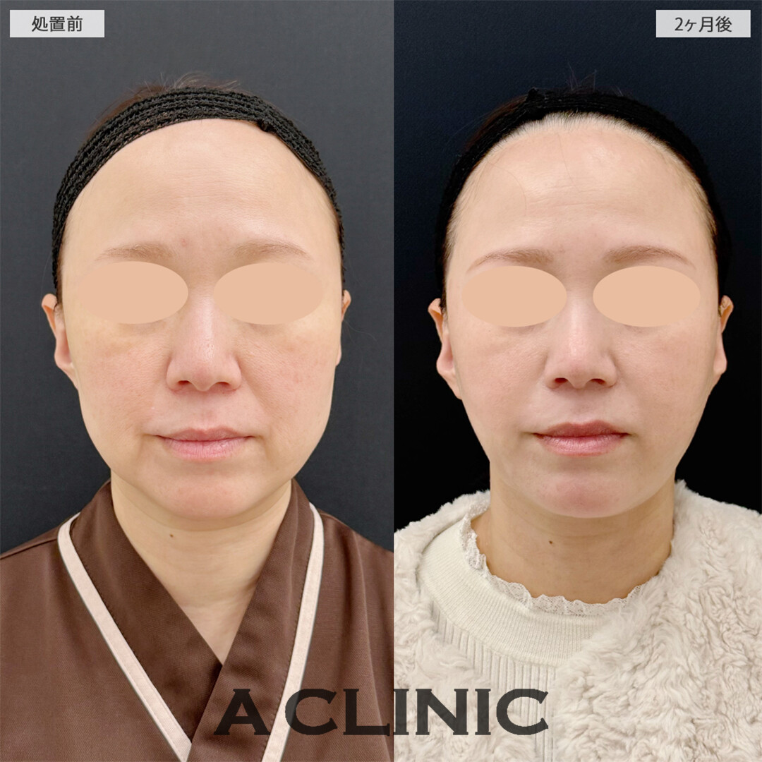1day小顔脂肪吸引と小顔エラボトックスで念願の卵形輪郭に！こちら処置前と2ヶ月後の症例です(40代女性)