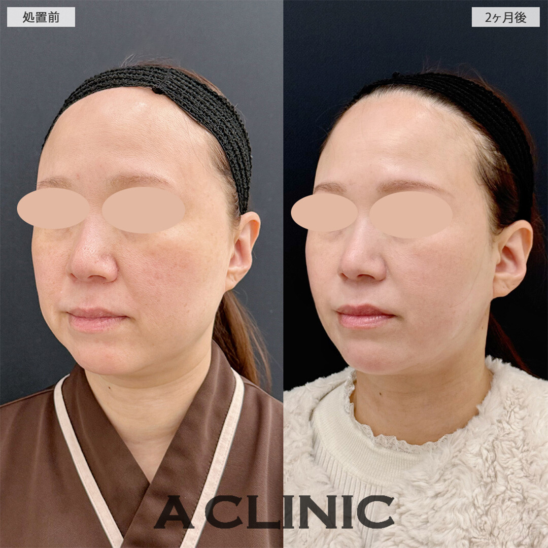 1day小顔脂肪吸引と小顔エラボトックスで念願の卵形輪郭に！こちら処置前と2ヶ月後の症例です(40代女性)