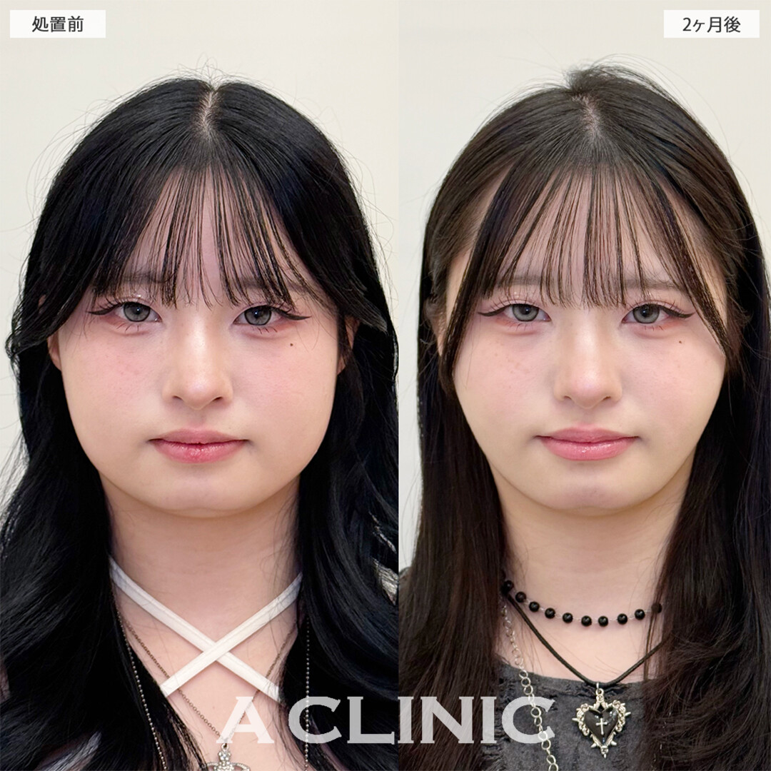 1day小顔脂肪吸引と小顔エラボトックスは最強の組み合わせ施術です！こちら処置前と2ヶ月後の症例です(20代女性)