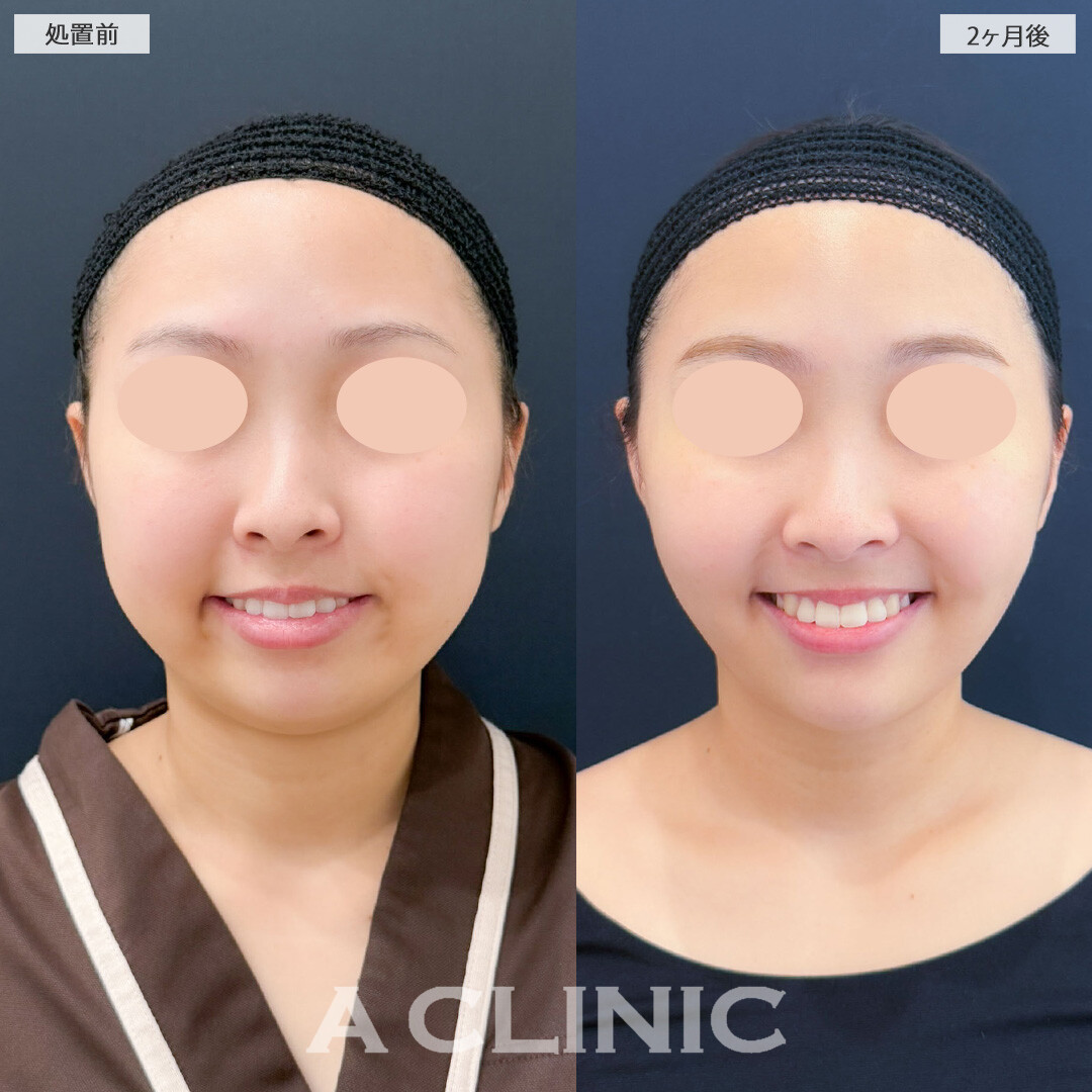 1day小顔脂肪吸引とバッカルファット除去術と小顔エラボトックスで余分な脂肪を除去し自然なスッキリフェイスになりました！処置前と2ヶ月後の症例です(20代女性)