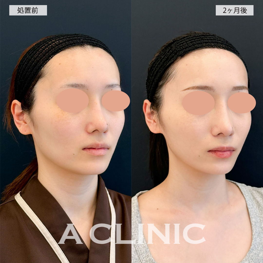 1day小顔脂肪吸引で顔全体が小さくなり女性らしい卵型の輪郭に！こちら処置前と2ヶ月後の症例です(20代女性)
