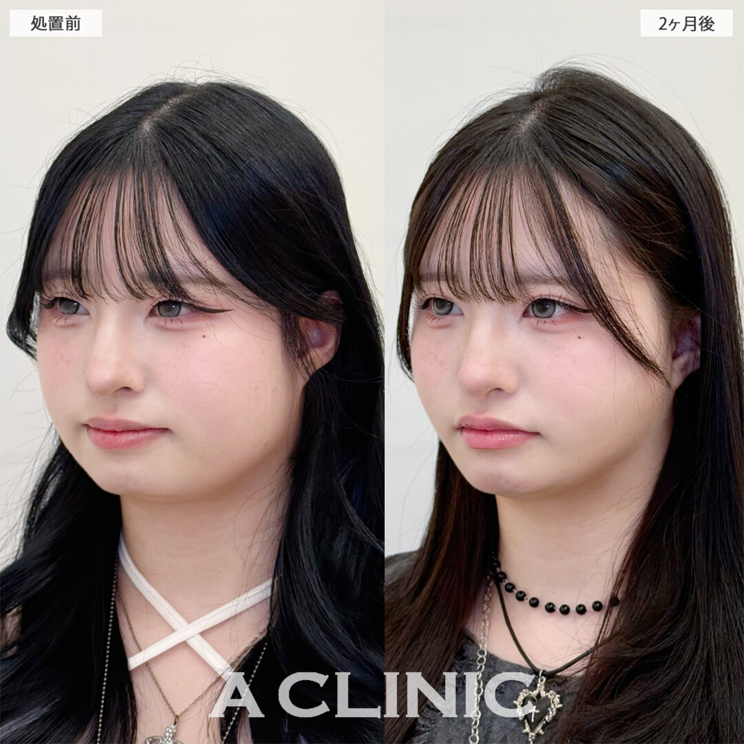 1day小顔脂肪吸引と小顔エラボトックスは最強の組み合わせ施術です！こちら処置前と2ヶ月後の症例です(20代女性)