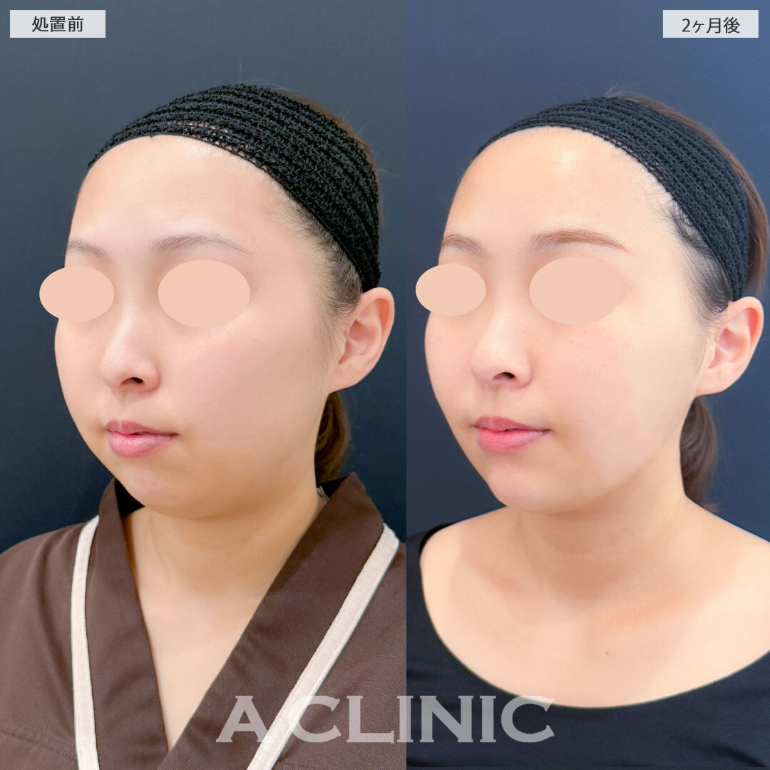 1day小顔脂肪吸引とバッカルファット除去術と小顔エラボトックスで余分な脂肪を除去し自然なスッキリフェイスになりました！処置前と2ヶ月後の症例です(20代女性)