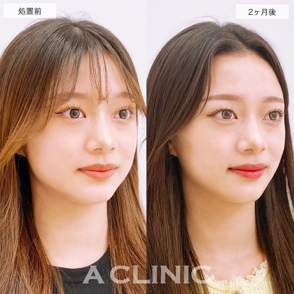 1day小顔脂肪吸引でどの角度から見てもスッキリ整った輪郭に変化！処置前と2ヵ月後の症例です(10代女性)