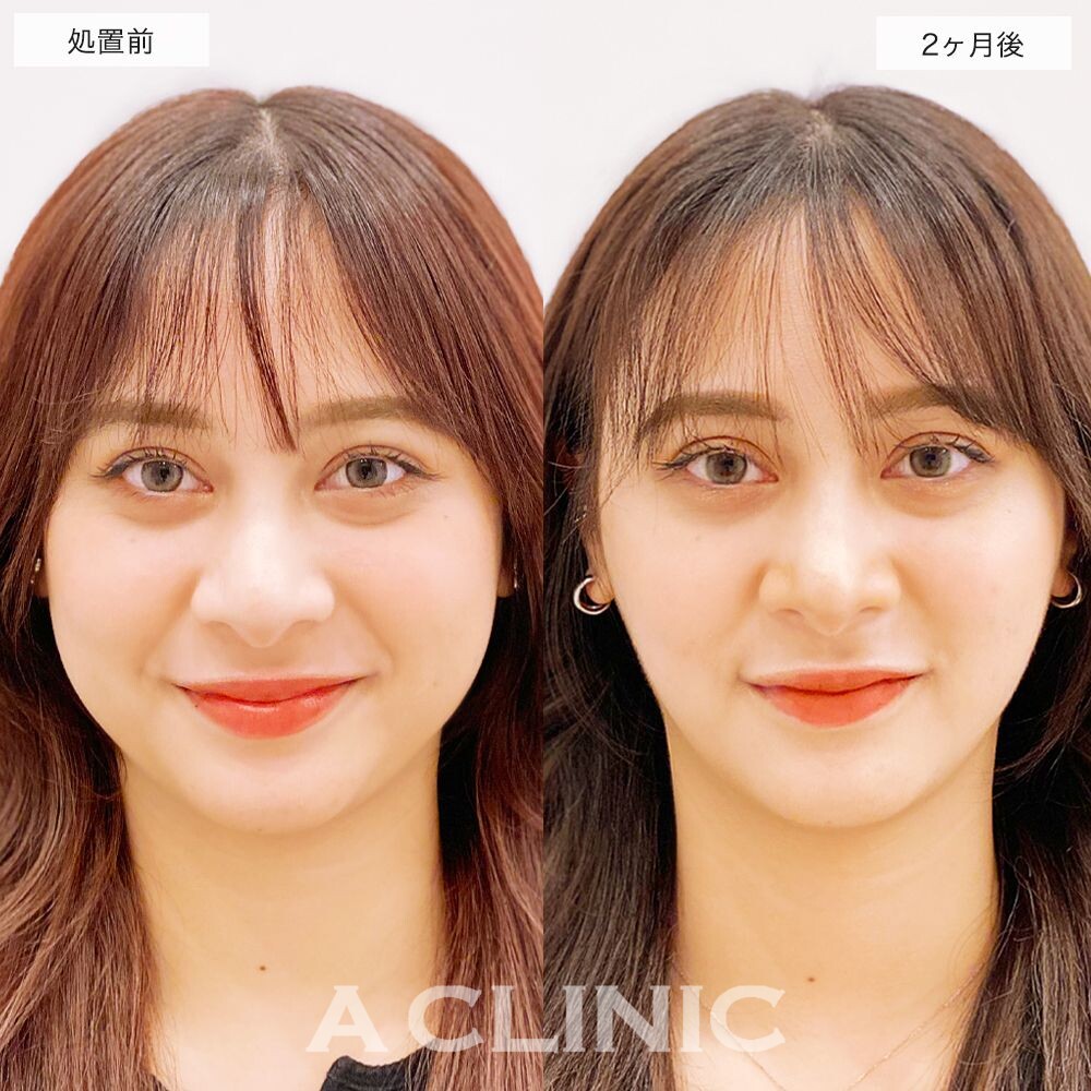 1day小顔脂肪吸引でスッキリとした綺麗なたまご型のフェイスラインに変化！処置前と2ヵ月後の症例です(20代女性)