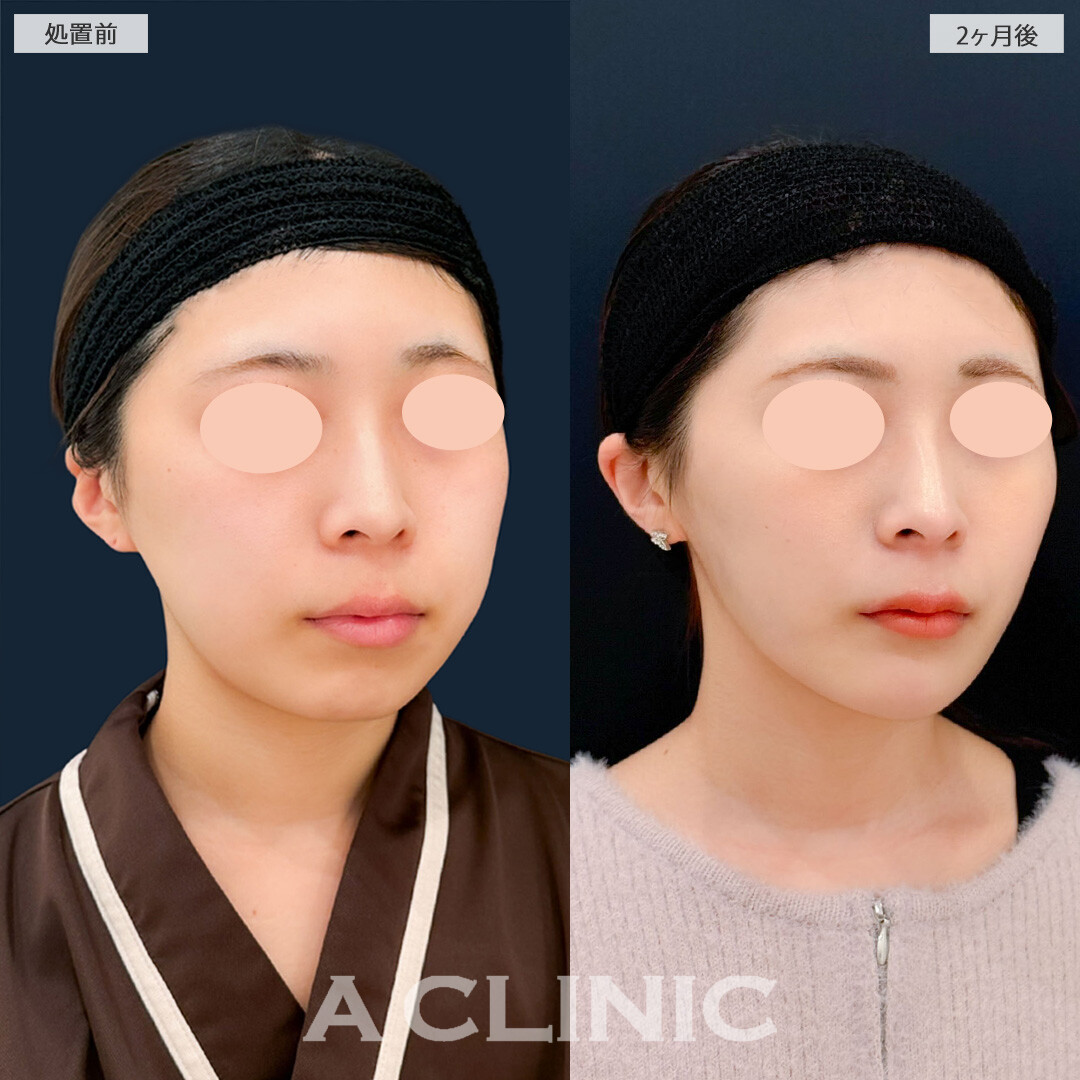 1day小顔脂肪吸引と小顔エラボトックスとあごへのヒアルロン酸注入で輪郭が整いスッキリフェイスラインに！こちら処置前と2ヶ月後の症例です(20代女性)