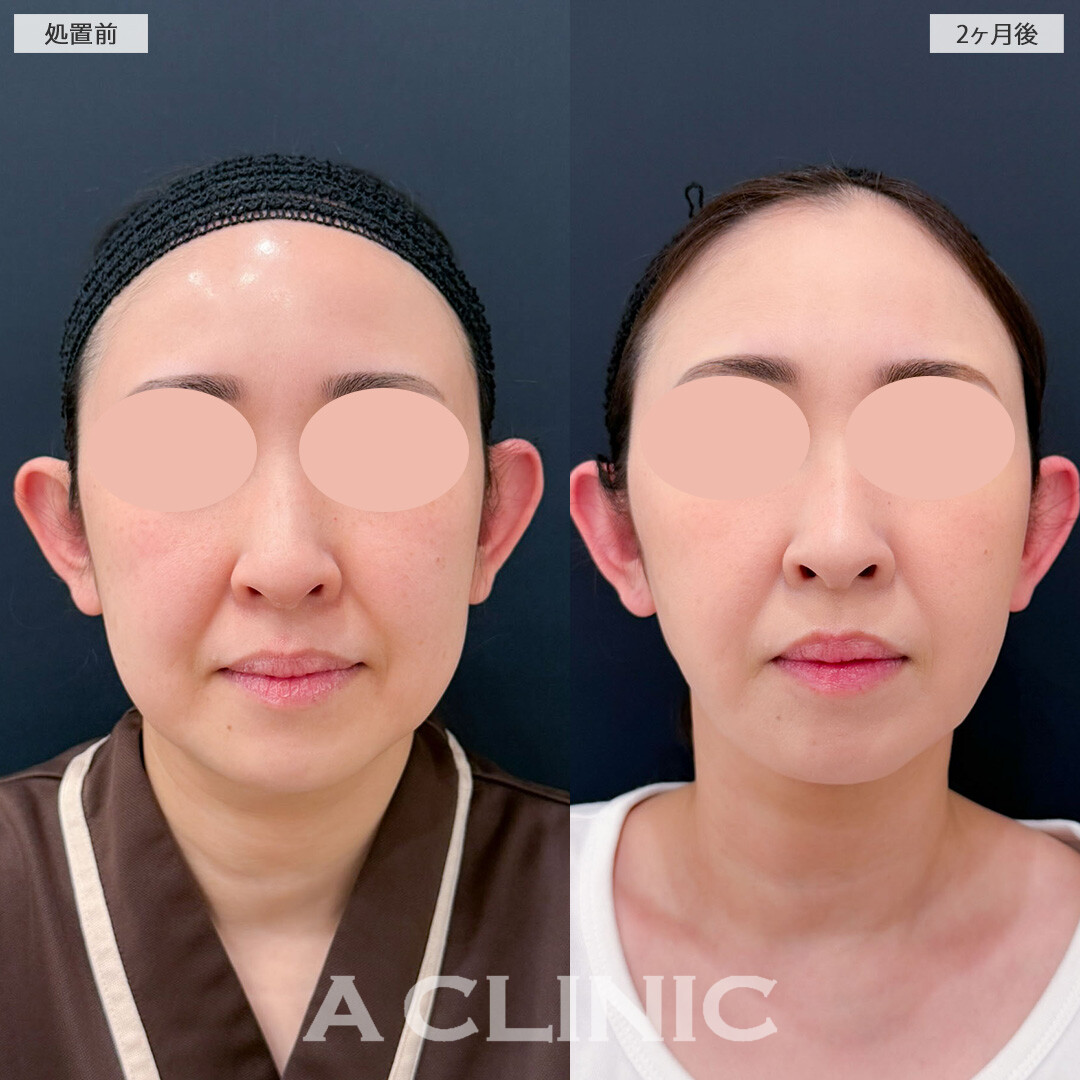 1day小顔脂肪吸引でたるみ引き上げてフェイスラインスッキリ！こちら処置前と2ヶ月後の症例です(40代女性)