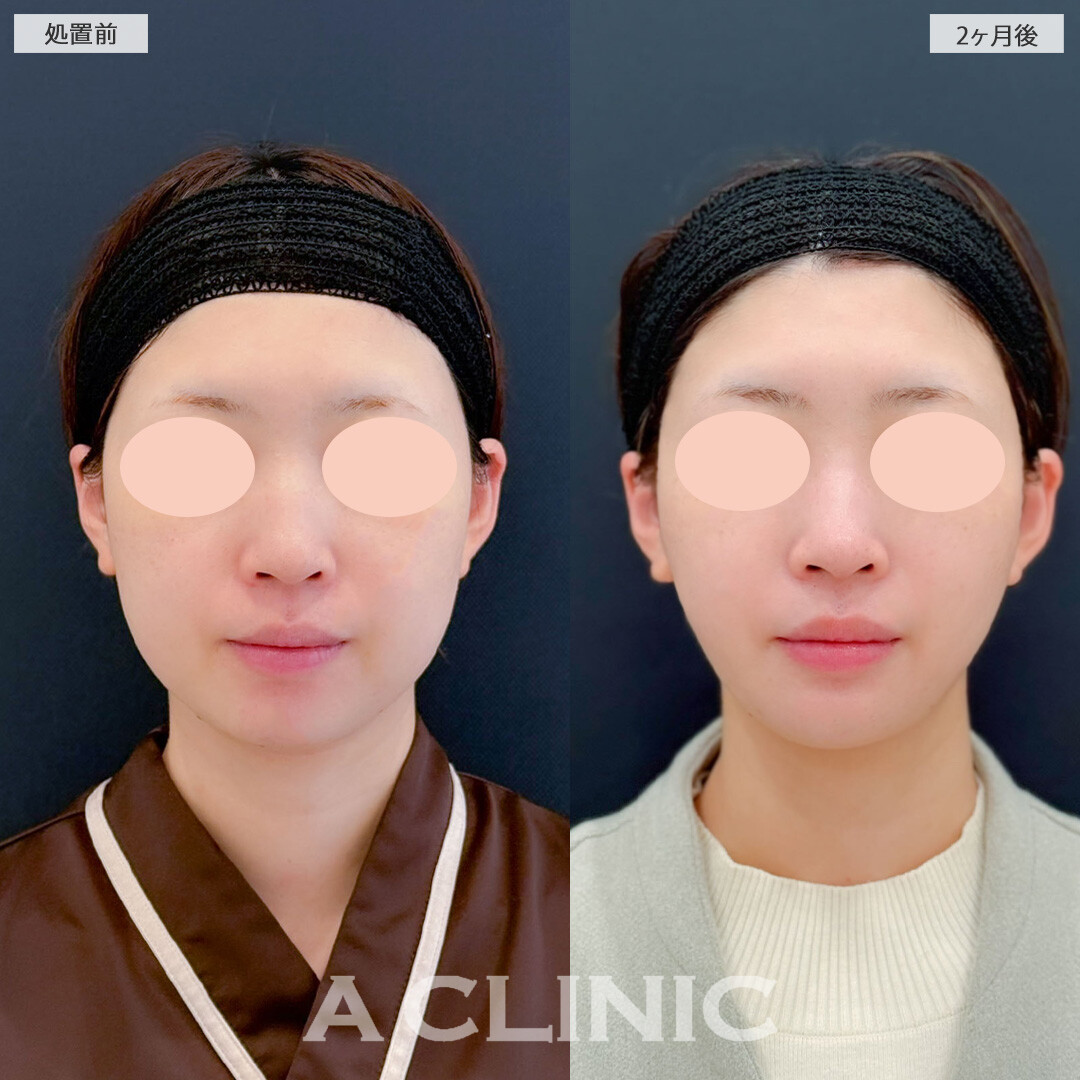 1day小顔脂肪吸引とバッカルファット除去術で余分な脂肪を除去し自然なスッキリフェイスラインに！こちら処置前と2ヶ月後の症例です(30代女性)