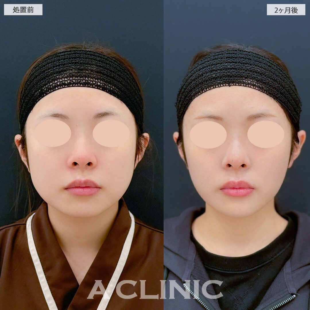 1day小顔脂肪吸引とバッカルファット除去術で気になる脂肪をしっかり除去しスッキリとしたフェイスラインになりました！こちら処置前と2ヶ月後の症例です(20代女性)