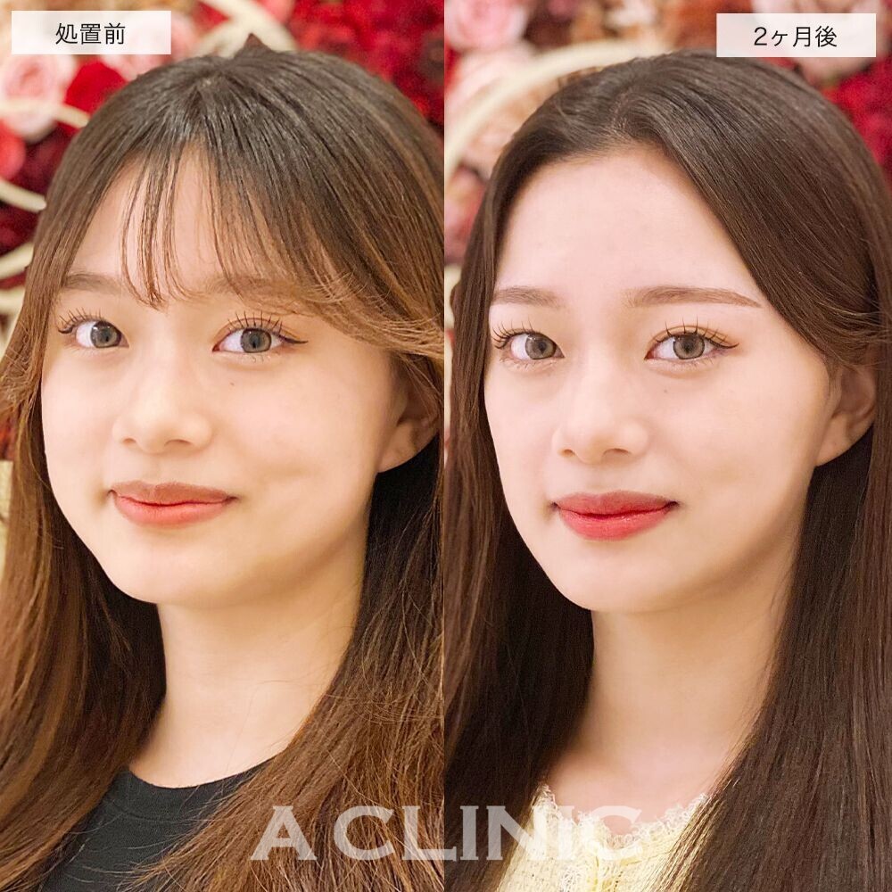 頬の脂肪が減りもたつきの無いスッキリとした輪郭に！1day小顔脂肪吸引の処置前と2ヵ月後の症例です(10代女性)