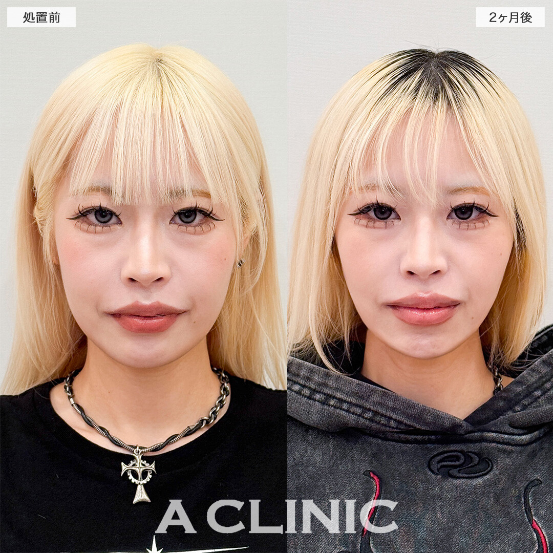 1day小顔脂肪吸引でアゴ下スッキリ美しいEラインが誕生しました！こちら処置前と２ヶ月後の症例です(20代女性)