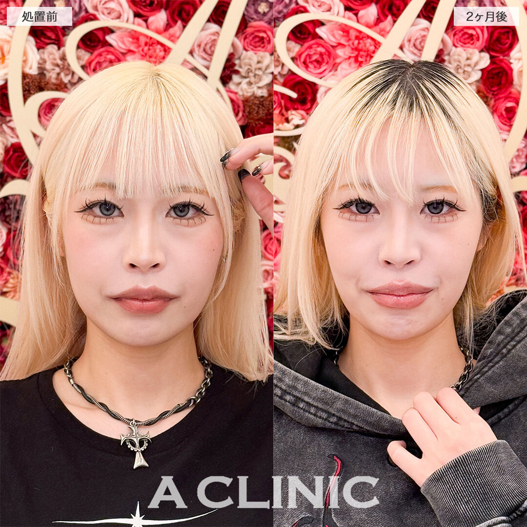 1day小顔脂肪吸引でアゴ下スッキリ美しいEラインが誕生しました！こちら処置前と２ヶ月後の症例です(20代女性)