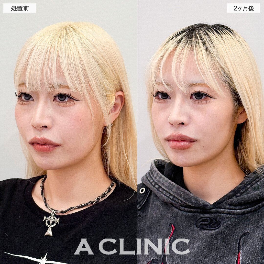 1day小顔脂肪吸引でアゴ下スッキリ美しいEラインが誕生しました！こちら処置前と２ヶ月後の症例です(20代女性)
