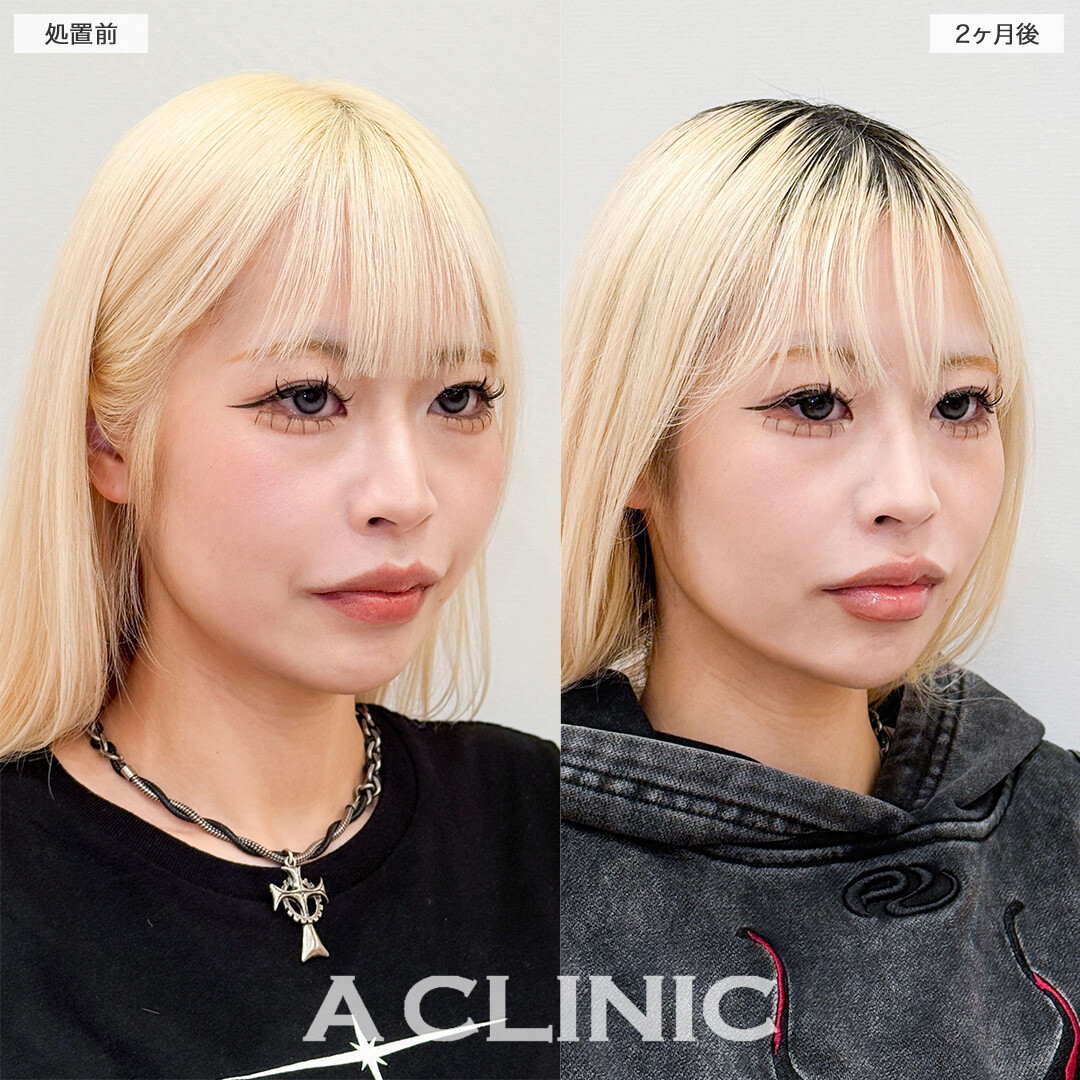 1day小顔脂肪吸引でアゴ下スッキリ美しいEラインが誕生しました！こちら処置前と２ヶ月後の症例です(20代女性)