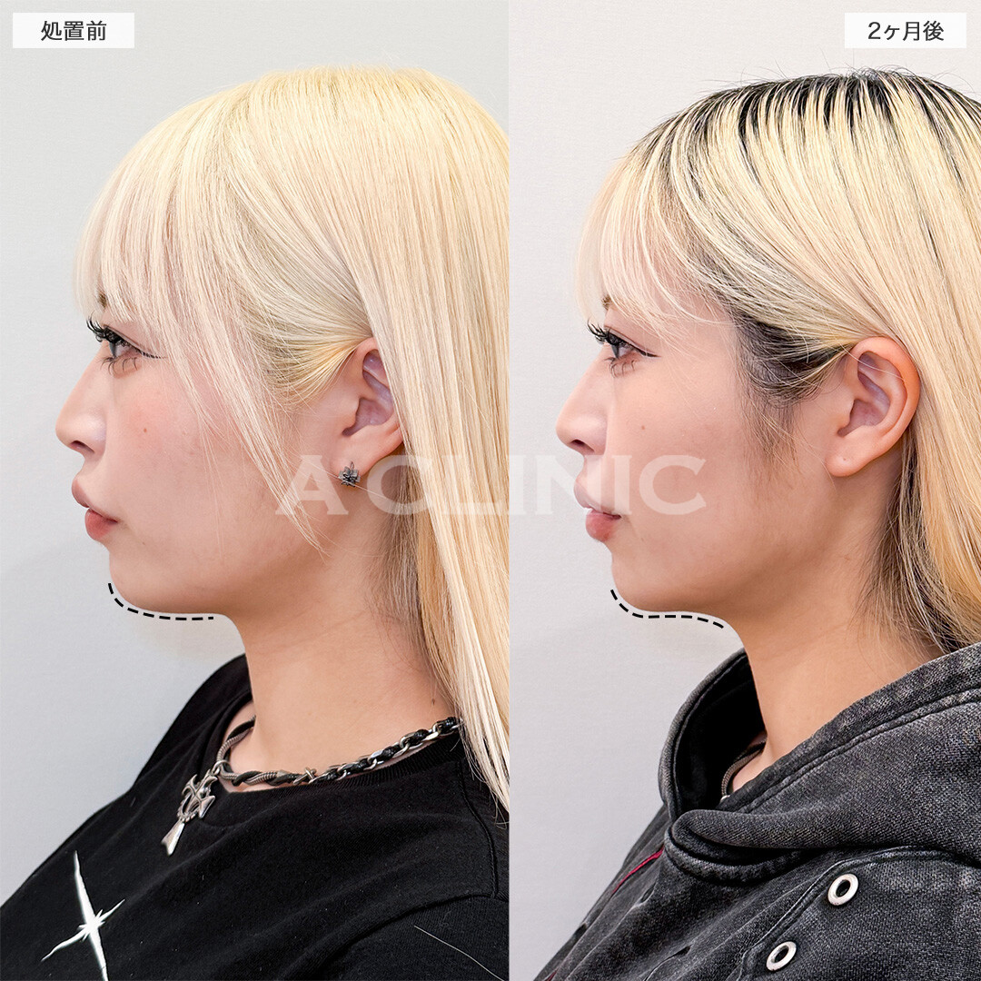 1day小顔脂肪吸引でアゴ下スッキリ美しいEラインが誕生しました！こちら処置前と２ヶ月後の症例です(20代女性)