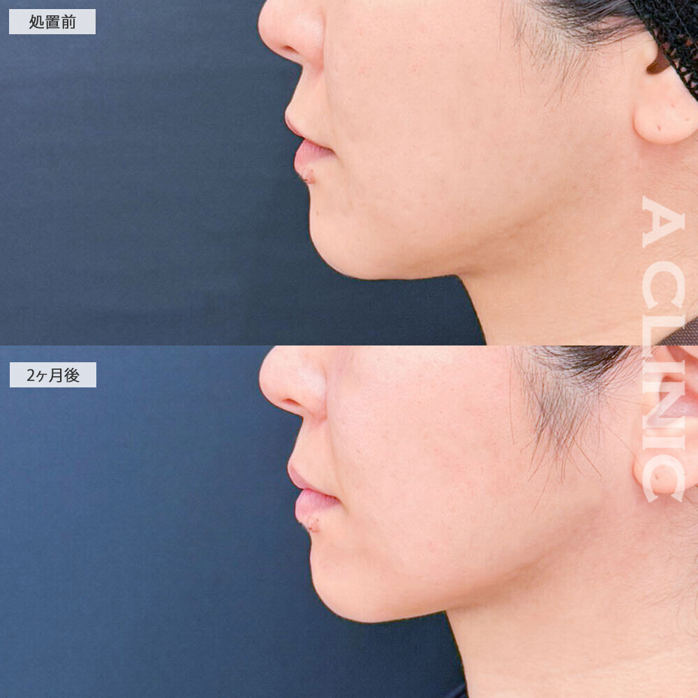 1day小顔脂肪吸引で横顔の印象がここまで変わる！こちら処置前から3ヶ月半後の症例です(40代女性)