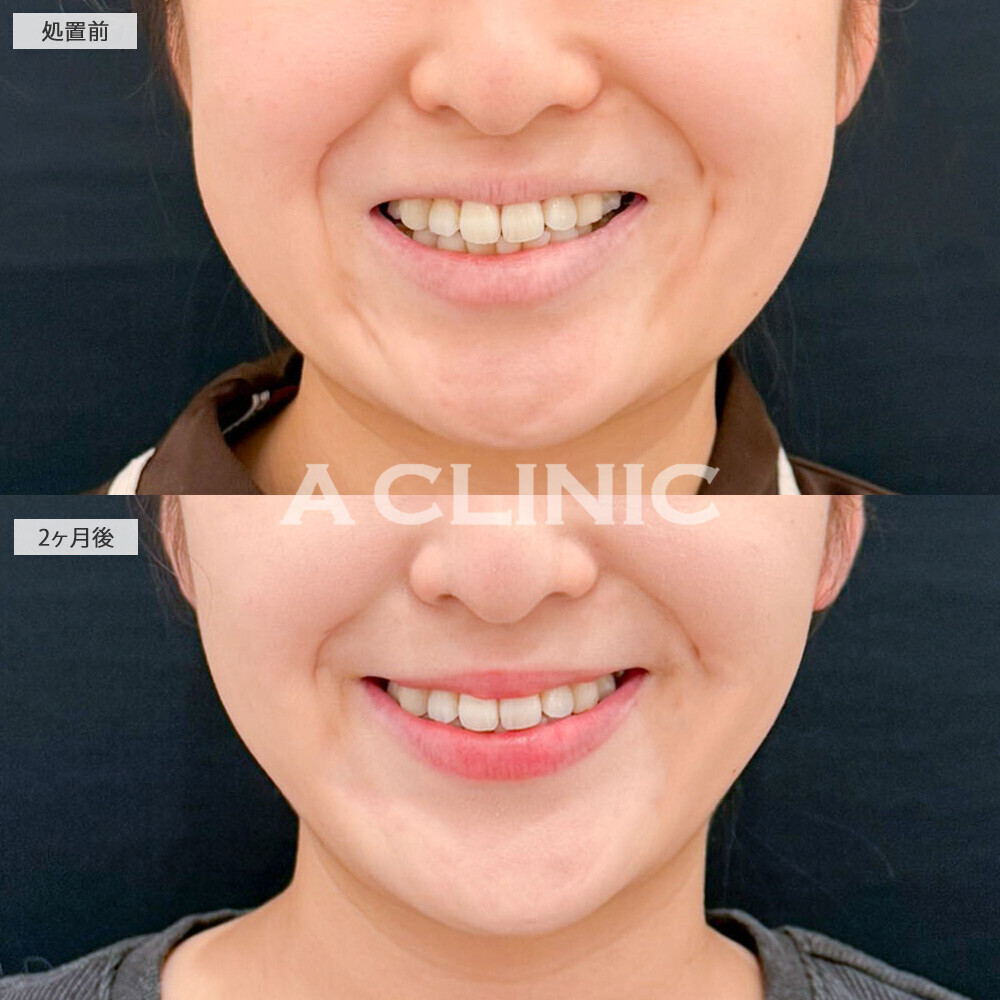 1day小顔脂肪吸引とバッカルファット除去術と小顔エラボトックスで頬のボリュームが激変！こちら処置前と2ヶ月後の症例です(20代女性)