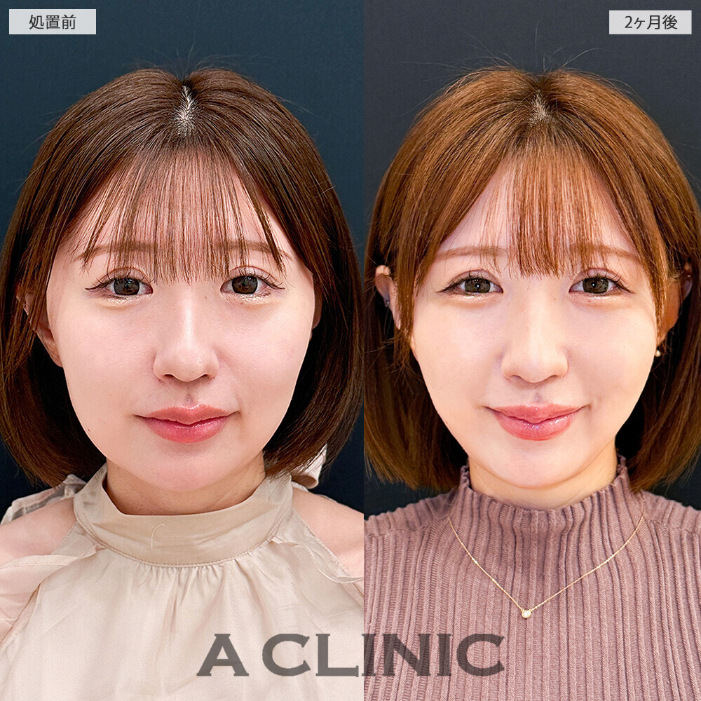 1day小顔脂肪吸引で余白がなくなり綺麗なVフェイスに！こちら処置前と2ヶ月後の症例です(30代女性)