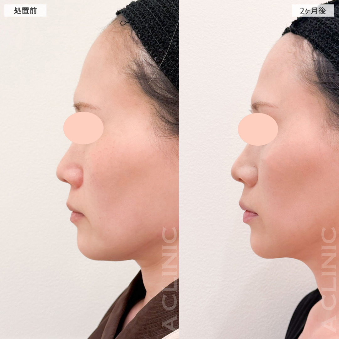 1day小顔脂肪吸引であご下のたるみが無くなりました！処置前から2ヶ月後の症例です(30代女性)