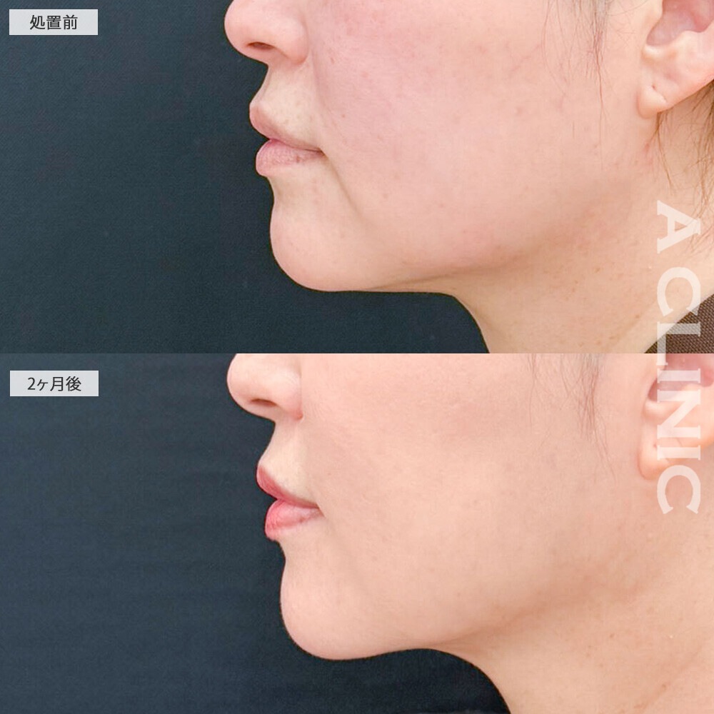 1day小顔脂肪吸引と注入処置の複合施術で脂肪もたるみもシワも全部解消！処置前と2ヶ月後の症例です(50代女性)