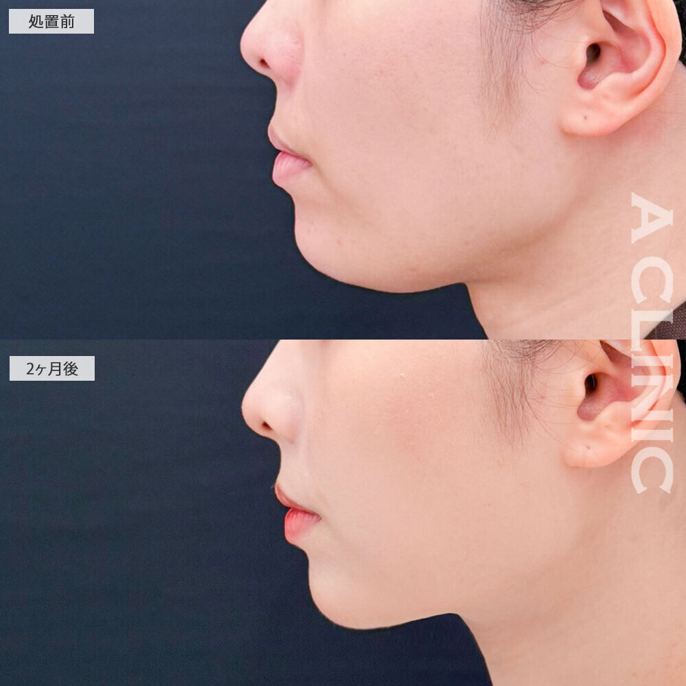 1day小顔脂肪吸引とボトックス注射(しわ)でクッキリ立体的な輪郭に！処置前から2ヶ月後の症例です(20代女性)