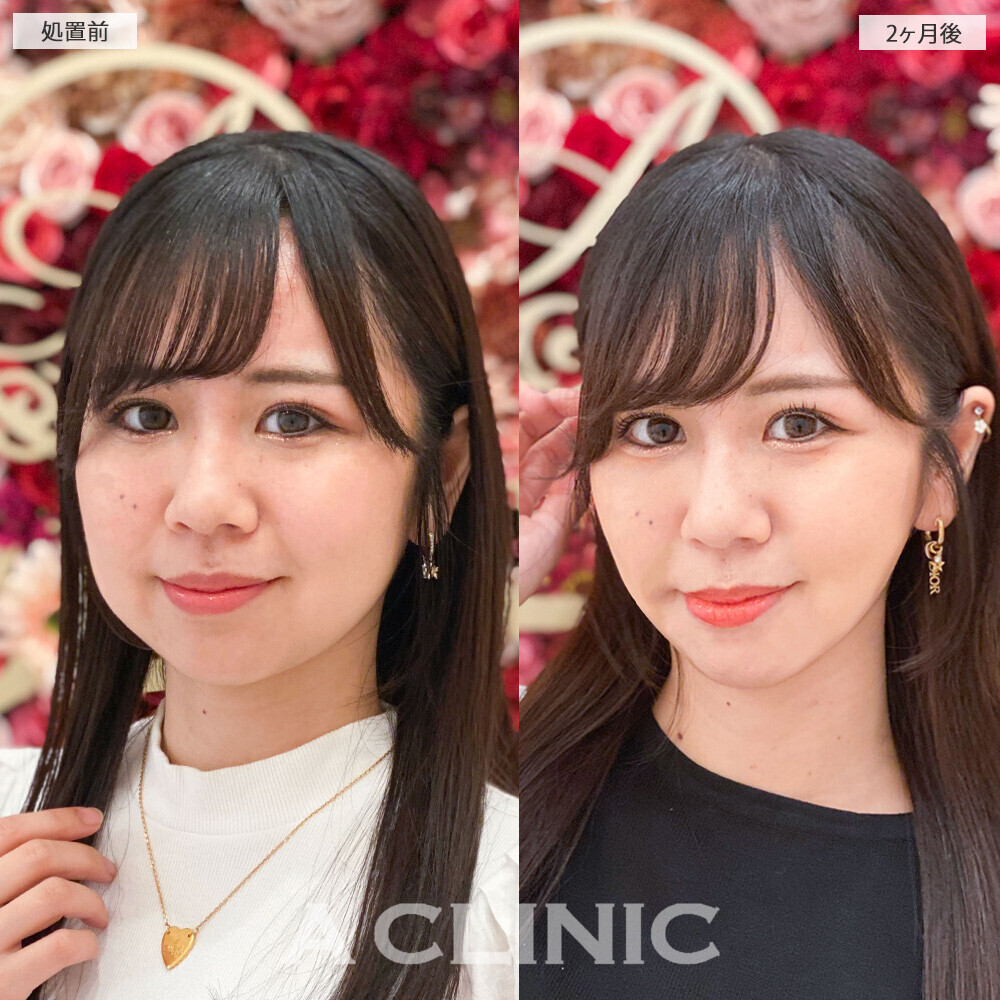 1day小顔脂肪吸引で下膨れ顔が綺麗なVフェイスに！こちら処置前と2ヶ月後の症例です(20代女性)