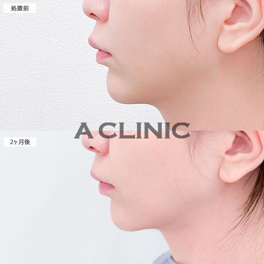 1day小顔脂肪吸引ならダイエットでも落ちにくいあご下の脂肪もここまでスッキリ！こちら処置前と2ヶ月後の症例です(20代女性)