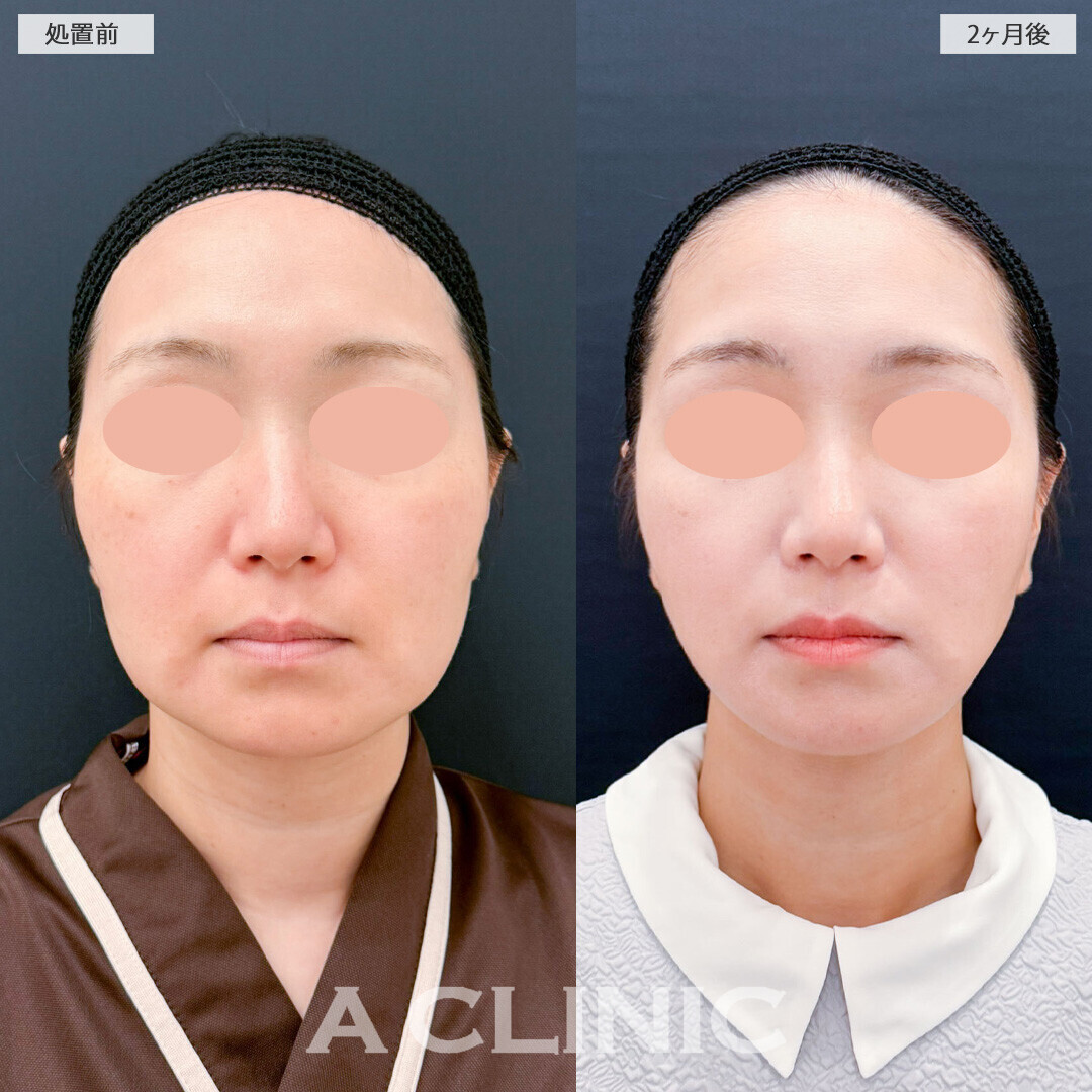 1day小顔脂肪吸引で口横のぷにっとした脂肪がスッキリしました！処置前と2ヶ月後の症例です(30代女性)