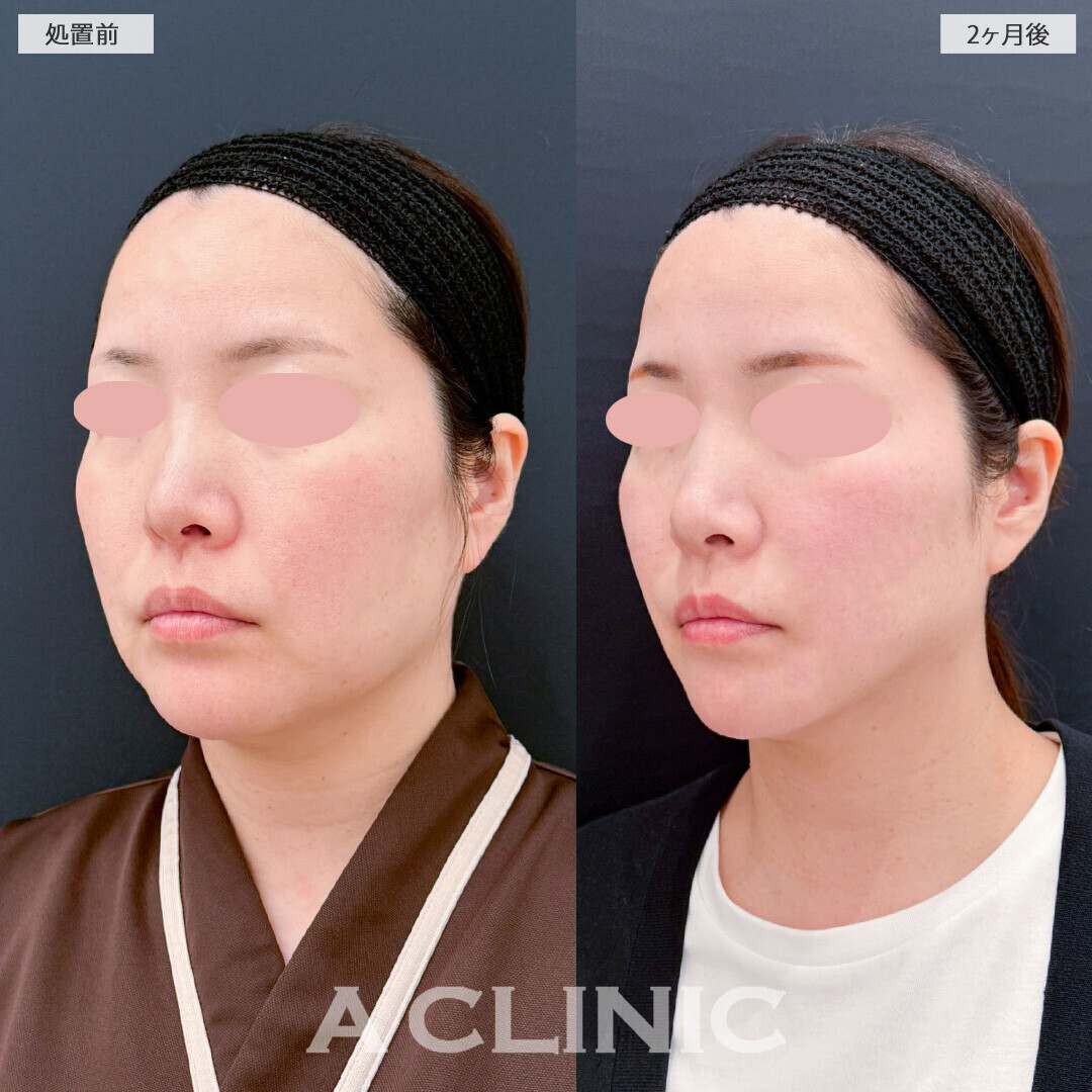 1day小顔脂肪吸引と小顔エラボトックスで若返り効果も抜群！処置前と2ヶ月後の症例です(40代女性)