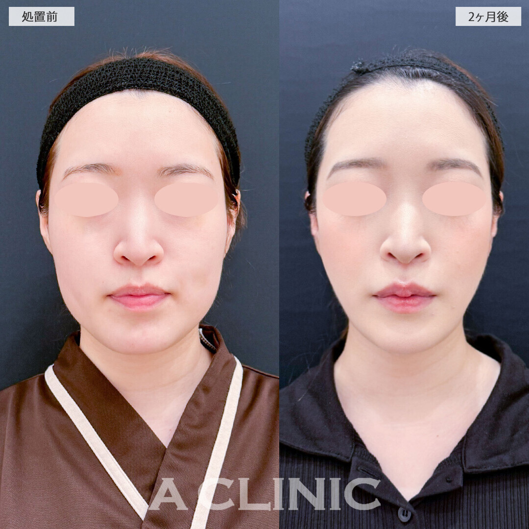 1day小顔脂肪吸引と小顔エラボトックスで女性らしい滑らかな輪郭に！処置前と2ヶ月後の症例です(20代女性)