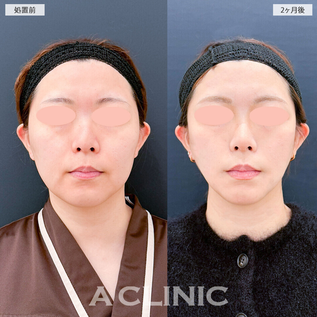 1day小顔脂肪吸引と小顔エラボトックスで余白が減り全体的にスッキリした印象に！処置前から2ヶ月後の症例です(30代女性)