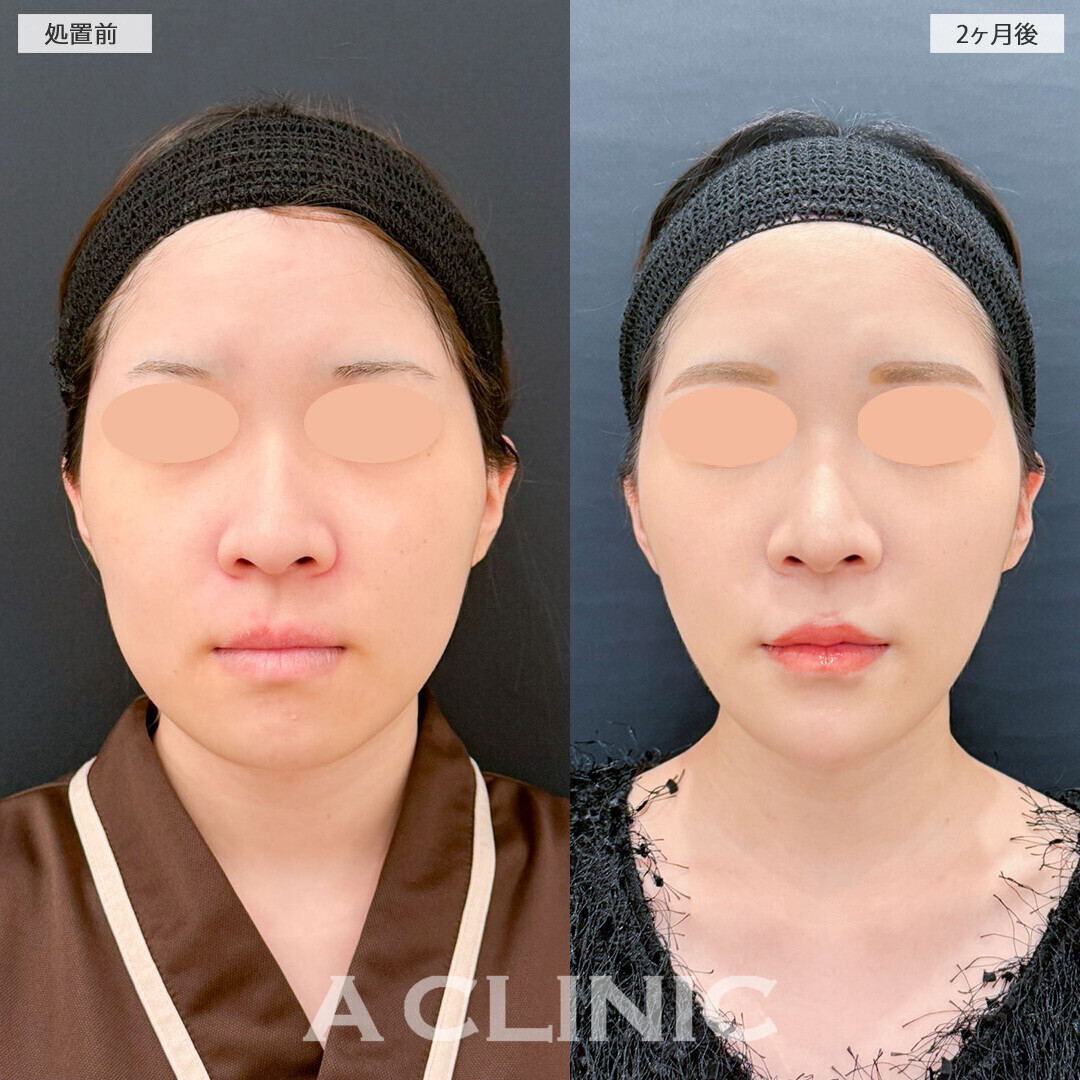 1day小顔脂肪吸引と小顔エラボトックスでどこから見てもしっかり小顔に！処置前と2ヶ月後の症例です(20代女性)