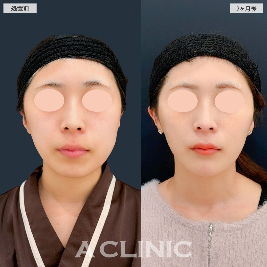 1day小顔脂肪吸引と小顔エラボトックスとあごへのヒアルロン酸注入で輪郭が整いスッキリフェイスラインに！こちら処置前と2ヶ月後の症例です(20代女性)
