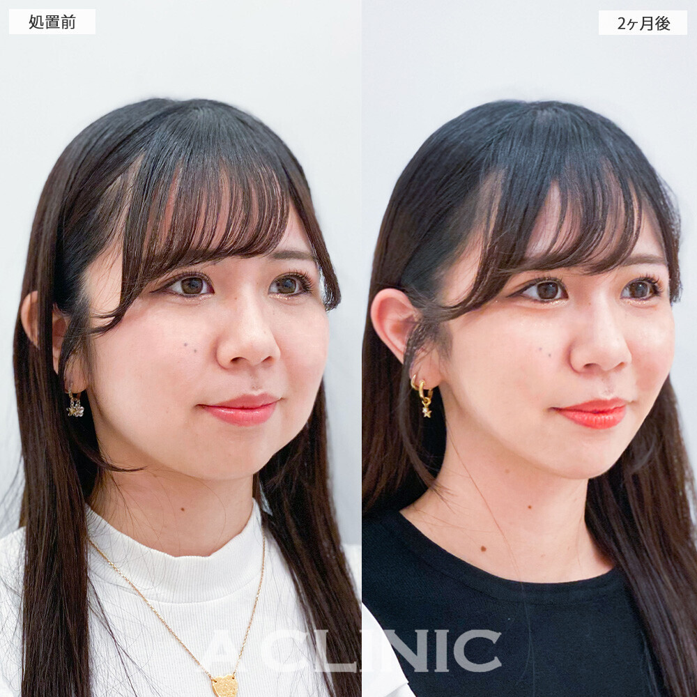 1day小顔脂肪吸引で下膨れ顔が綺麗なVフェイスに！こちら処置前と2ヶ月後の症例です(20代女性)