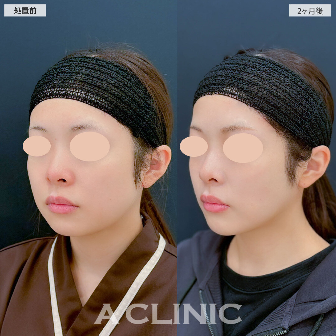 1day小顔脂肪吸引とバッカルファット除去術で気になる脂肪をしっかり除去しスッキリとしたフェイスラインになりました！こちら処置前と2ヶ月後の症例です(20代女性)