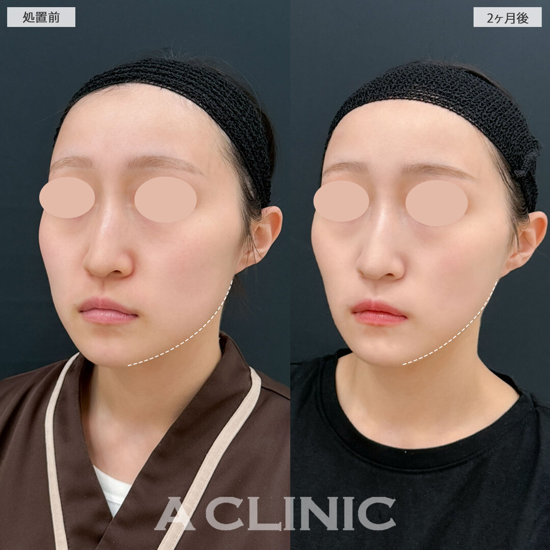 1day小顔脂肪吸引とバッカルファット除去術と小顔エラボトックスで下膨れが解消されスッキリフェイスラインに！こちら処置前と2ヶ月後の症例です(20代女性)