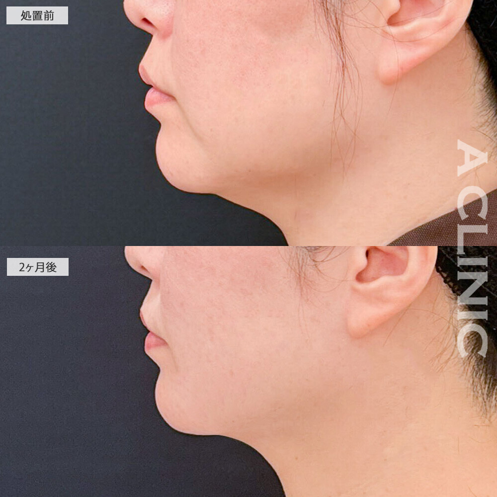 1day小顔脂肪吸引と小顔エラボトックスで若返り効果も抜群！処置前と2ヶ月後の症例です(40代女性)
